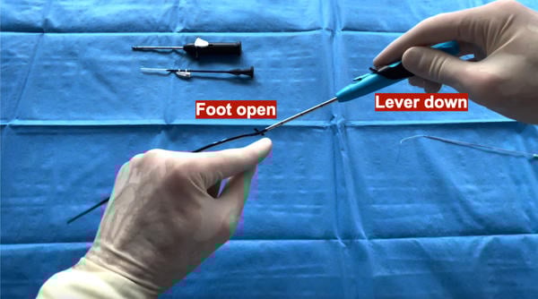 Uncoupling of the foot from the lever in the Prostyle device, leading to device entrapment in calcific and complex anatomies