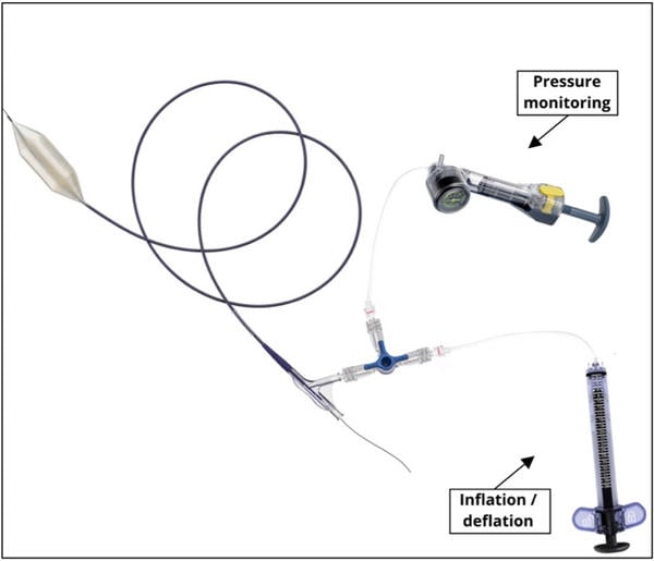 Simplified Dual-Indeflator Approach for Bioprosthetic Valve Fracture - Figure 1
