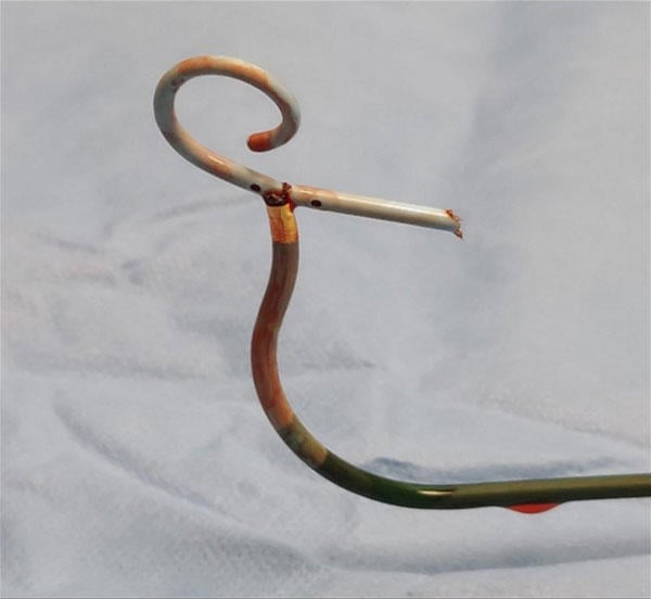 Performing BASILICA: A Step-by-Step Guide to Prevent Coronary Obstruction During TAVI - The invited Expert's opinion - Figure 1