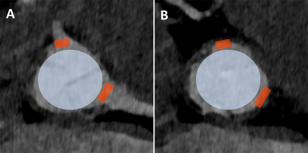 Performing BASILICA: A Step-by-Step Guide to Prevent Coronary Obstruction During TAVI - Figure 1