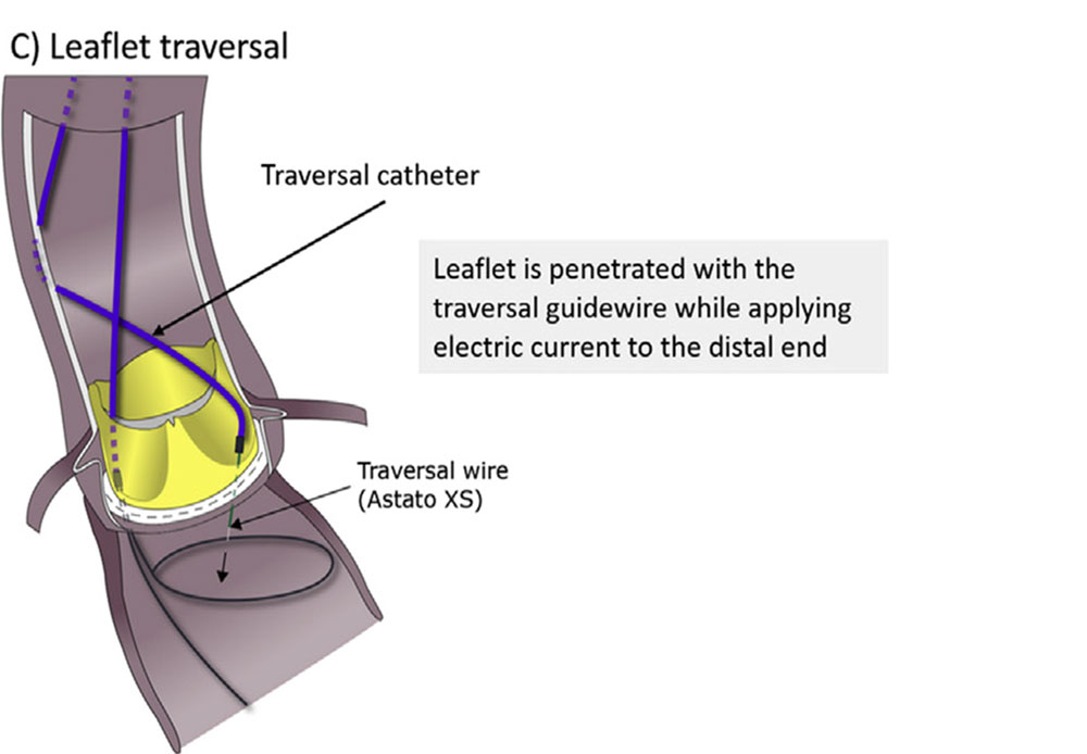 Performing BASILICA: A Step-by-Step Guide to Prevent Coronary Obstruction During TAVI - Figure 5