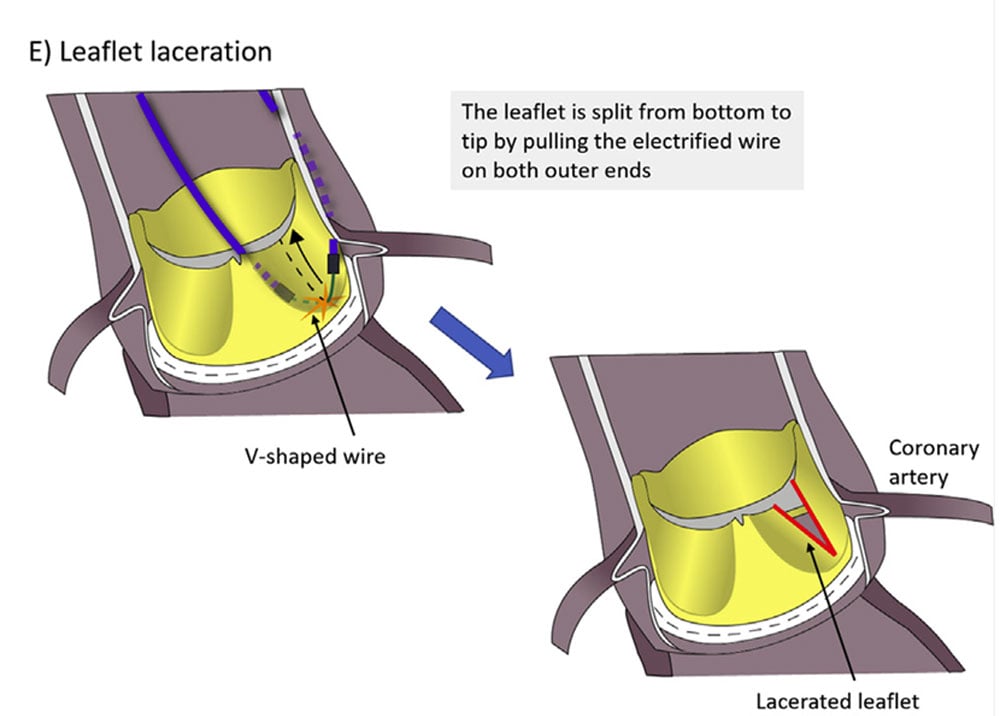 Performing BASILICA: A Step-by-Step Guide to Prevent Coronary Obstruction During TAVI - Figure 6
