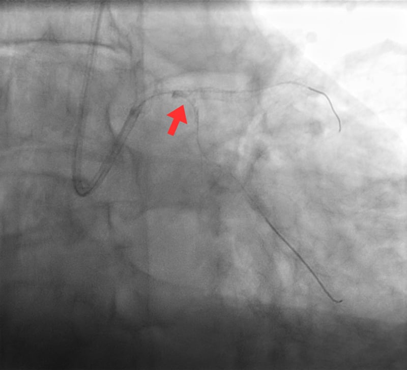 A novel bailout technique for the percutaneous extraction of an entrapped coronary guidewire beneath a crushed stent - Figure 1