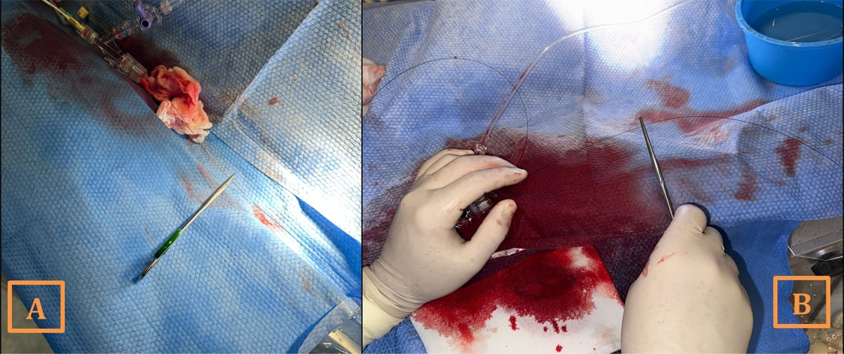 A novel bailout technique for the percutaneous extraction of an entrapped coronary guidewire beneath a crushed stent - Figure 2