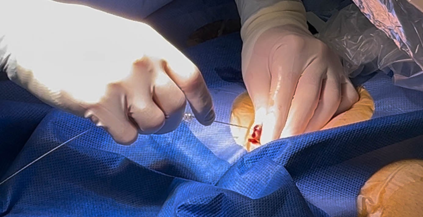 MicroSafety The Ipsilateral Safety Wire Technique Figure4