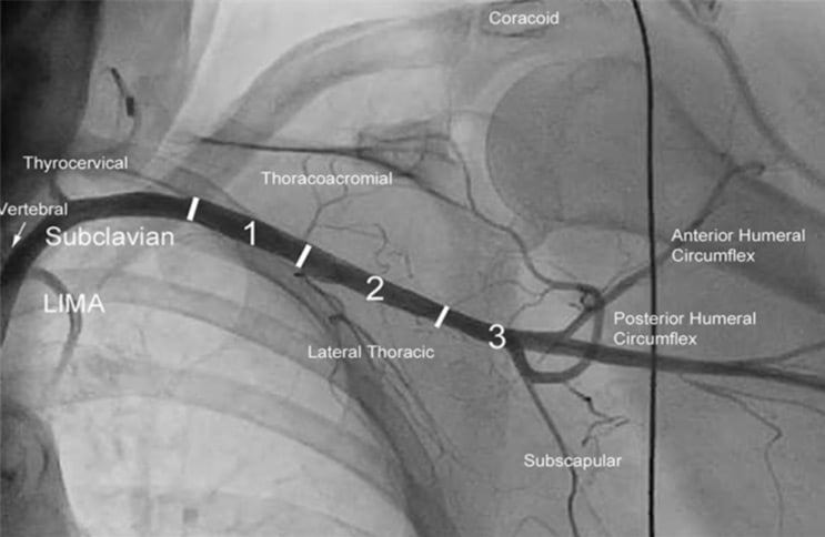 TAVI: Easy Axillary Approach, prefer left axillary in most cases for a more favorable orientation to the aortic valve