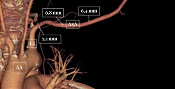 TAVI: Easy Axillary Approach, CT scan reconstruction with dimensions (essential to evaluate for access use)