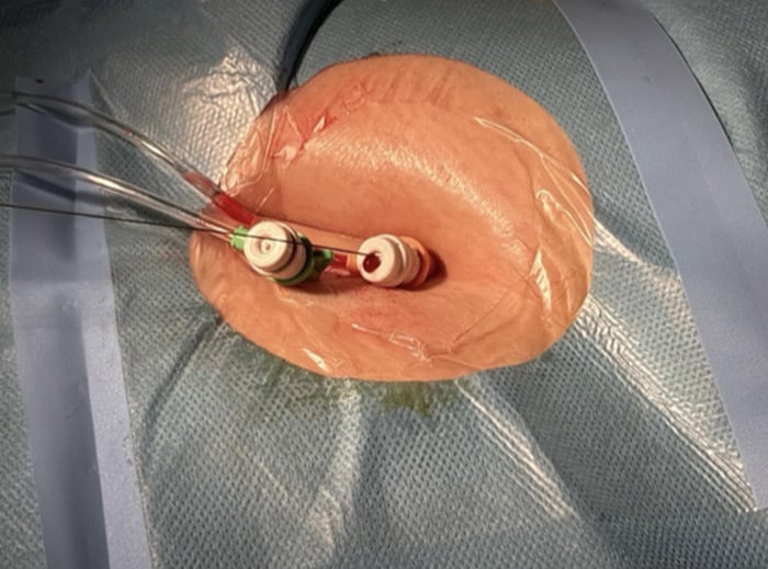 TAVI: Easy Axillary Approach, 7Fr sheath in the  femoral artery (for control angiography and bailout interventions) 6Fr-sheath for PMK