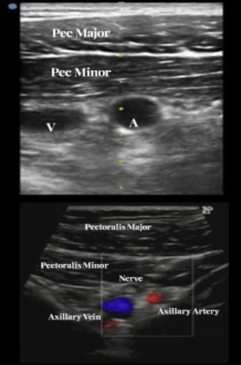 TAVI: Easy Axillary Approach, ultrasound identification of axillary artery, vein and nerve plexus