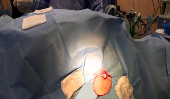 TAVI: Easy Axillary Approach, axillary access with prostyle positioned and 10 Fr in place