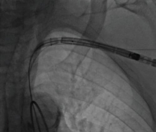 TAVI: Easy Axillary Approach, passage of the valve delivery from the axillary artery, through the subclavian artery into the aorta