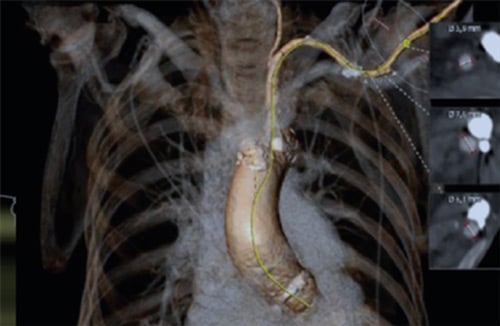 TAVI: Easy Axillary Approach, CT scan reconstruction with center line
