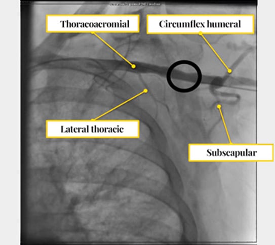 TAVI: Easy Axillary Approach, reference collateral arteries