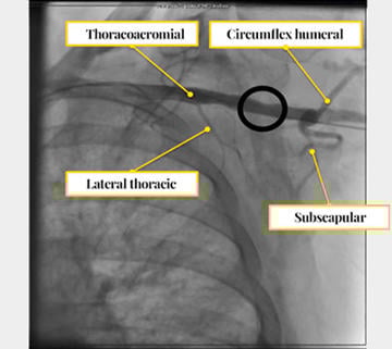 TAVI: Easy Axillary Approach, reference collateral arteries