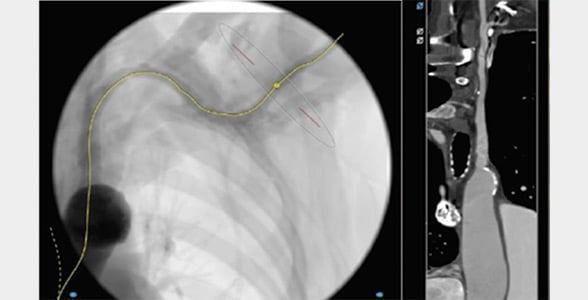 TAVI: Easy Axillary Approach, center line and straight view