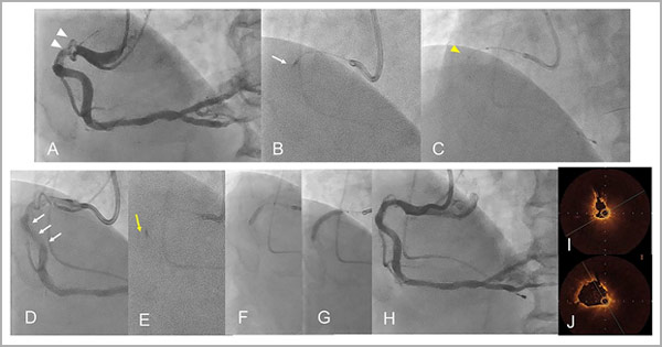 Supplementary Figure 1: rotational atherectomy combined with a guide extension catheter