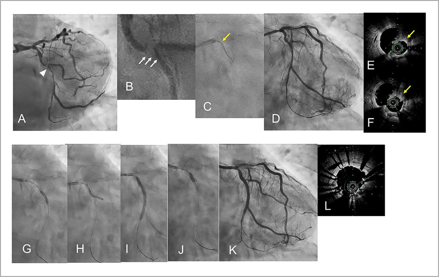 Supplementary Figure 2: A representative case of a 73-year-old male treated with orbital atherectomy combined with a GEC [Case No. 5].