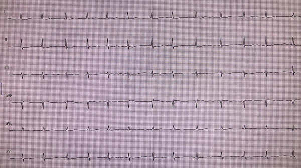 ECG at discharge (3rd postprocedural day)