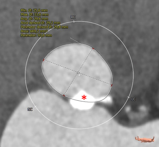 LVOT dimensions at 2 mm