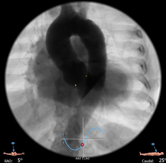 C-arm angulation: Cusp overlap view