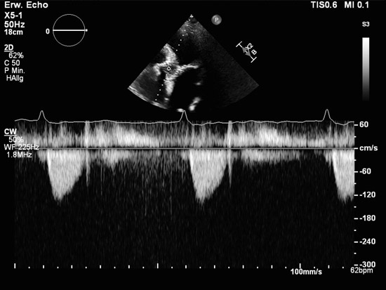 Transthoracic echocardiography at discharge (3rd postprocedural day)
