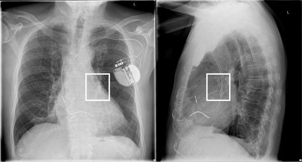 Wie sollte ich einen Patienten mit unzureichendem chirurgischen Verschluss des linken Vorhofohrs behandeln - Abbildung 1