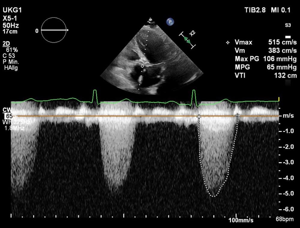 Aortic stenosis - small anatomy - low coronary distance and extremely horizontal aorta - Figure 1