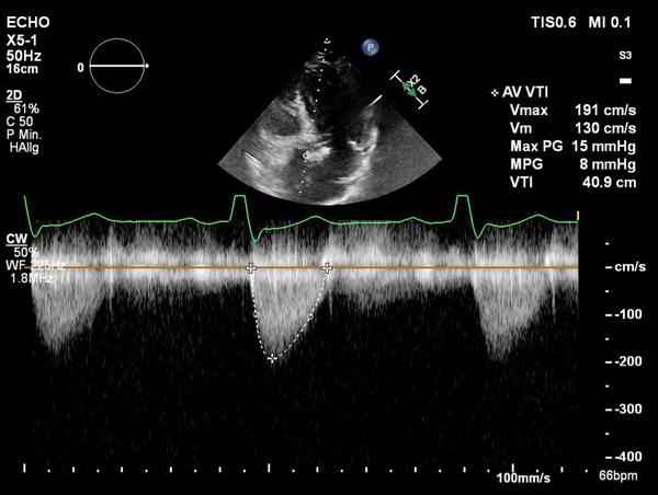Aortenklappenstenose: kleine Anatomie, geringer Koronarabstand und extrem horizontale Aorta - Abbildung 10
