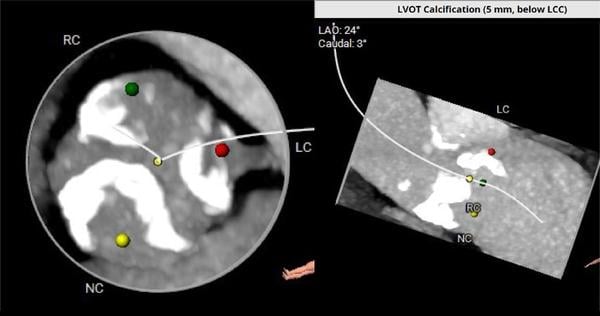 Aortenklappenstenose: kleine Anatomie, geringer Koronarabstand und extrem horizontale Aorta - Abbildung 3