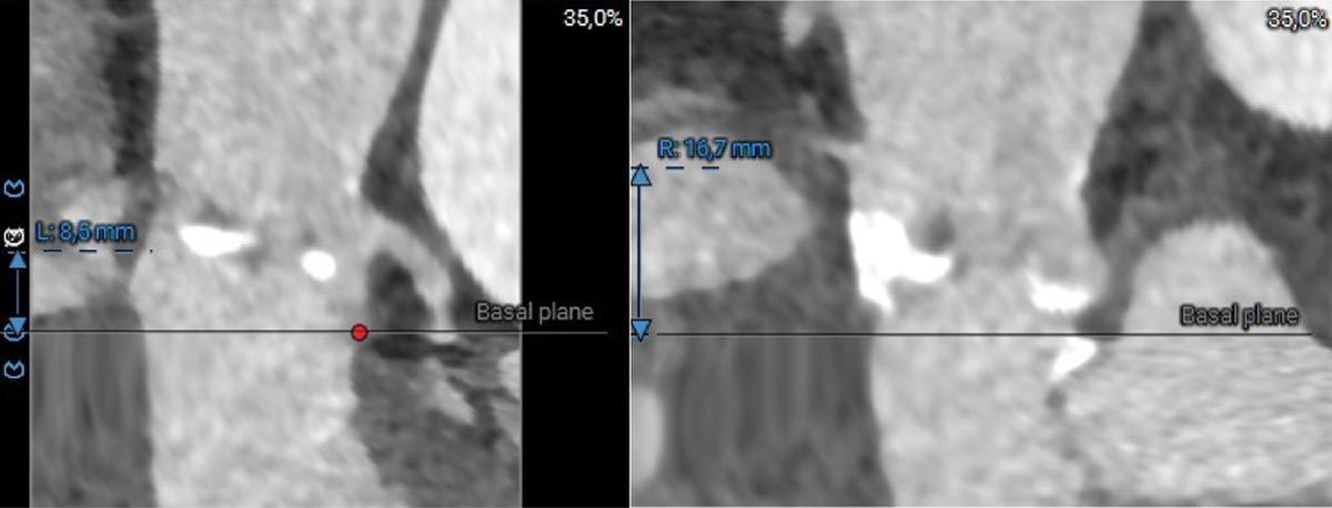 Aortenklappenstenose: kleine Anatomie, geringer Koronarabstand und extrem horizontale Aorta - Abbildung 4