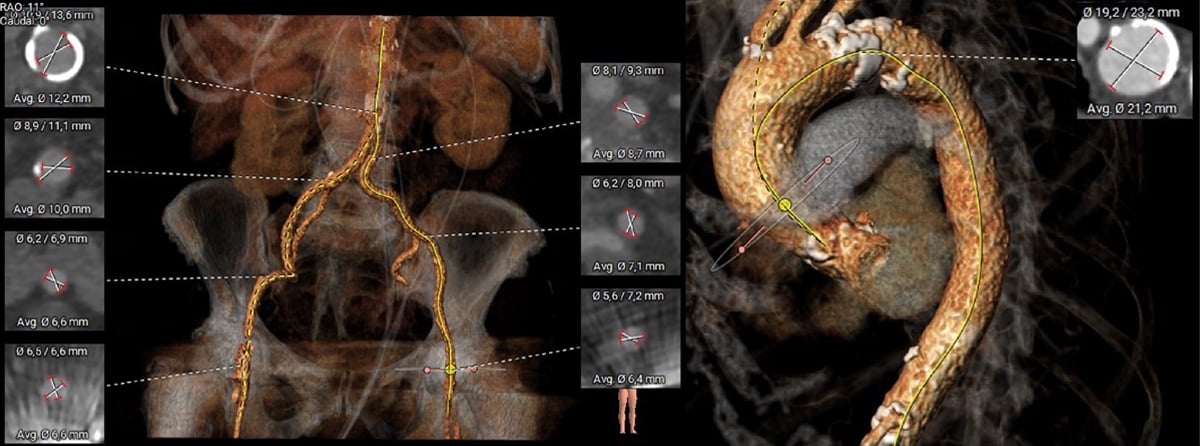 Aortenklappenstenose: kleine Anatomie, geringer Koronarabstand und extrem horizontale Aorta - Abbildung 5