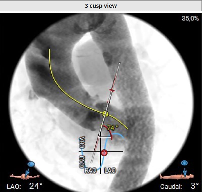 Aortenklappenstenose: kleine Anatomie, geringer Koronarabstand und extrem horizontale Aorta - Abbildung 6
