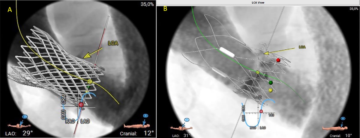 Aortenklappenstenose: kleine Anatomie, geringer Koronarabstand und extrem horizontale Aorta - Abbildung 7