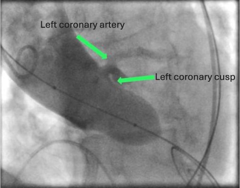 Aortenklappenstenose: kleine Anatomie, geringer Koronarabstand und extrem horizontale Aorta - Abbildung 8