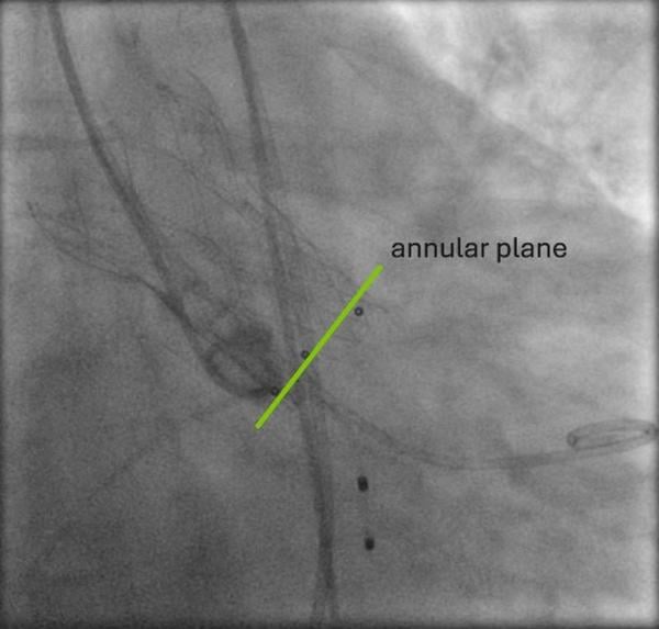 Aortenklappenstenose: kleine Anatomie, geringer Koronarabstand und extrem horizontale Aorta - Abbildung 9