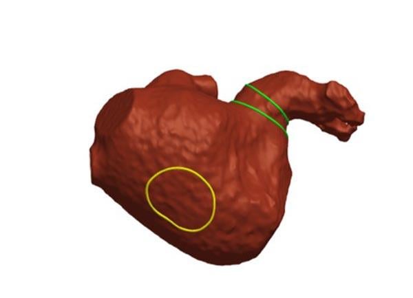 How should I treat? Sealing the Risk: A Case of Left Atrial Appendage Closure - Figure 1