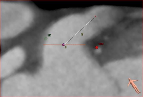 How should I treat? Sealing the Risk: A Case of Left Atrial Appendage Closure - Figure 4