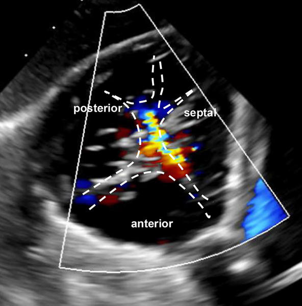 Auswirkungen der GDMT auf das Langzeitergebnis nach trikuspidalem TEER - Abbildung 1