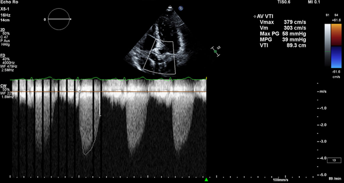 Neue Wege beginnen dort, wo alte enden: ein TAVR-Fall - Abbildung 1