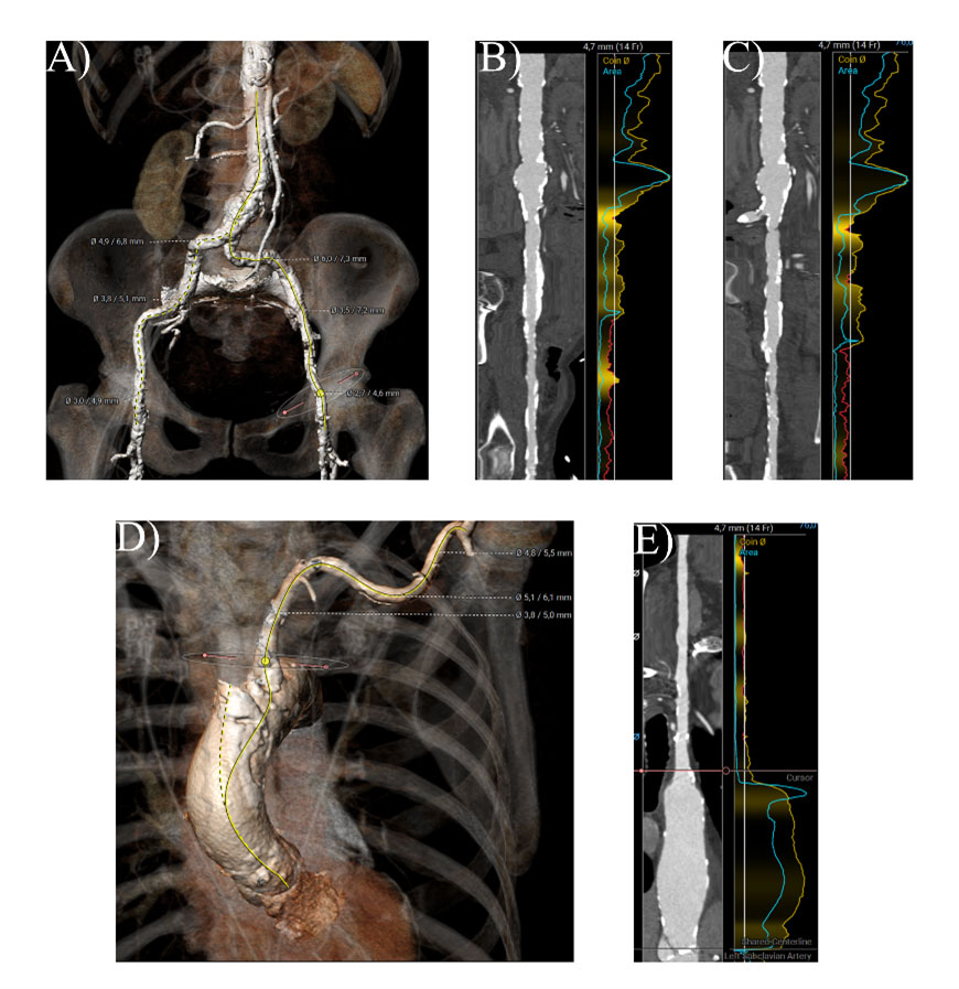 Neue Wege beginnen dort, wo alte enden: ein TAVR-Fall - Abbildung 3
