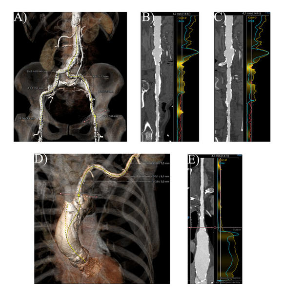 Neue Wege beginnen dort, wo alte enden: ein TAVR-Fall - Abbildung 3