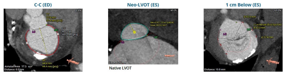 Severe Mitral Regurgitation in a High-risk patient with a suboptimal anatomy for M-TEER - Figure1