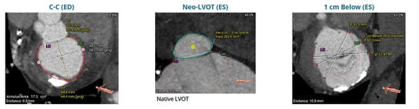 Severe Mitral Regurgitation in a High-risk patient with a suboptimal anatomy for M-TEER - Figure1