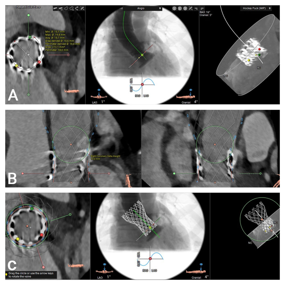 Treating severe restenosis of a 20-mm balloon-expanding valve after a transapical approach with a risk of coronary obstruction - Figure 2