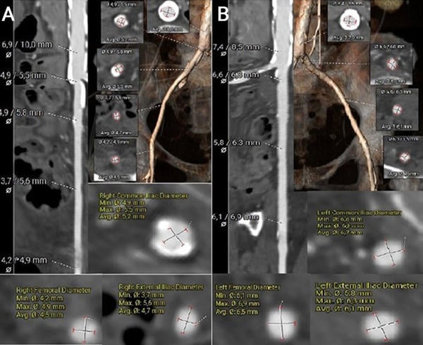 Treating severe restenosis of a 20-mm balloon-expanding valve after a transapical approach with a risk of coronary obstruction - Figure 3
