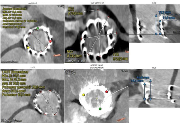 Treating severe restenosis of a 20-mm balloon-expanding valve after a transapical approach with a risk of coronary obstruction - Figure 4