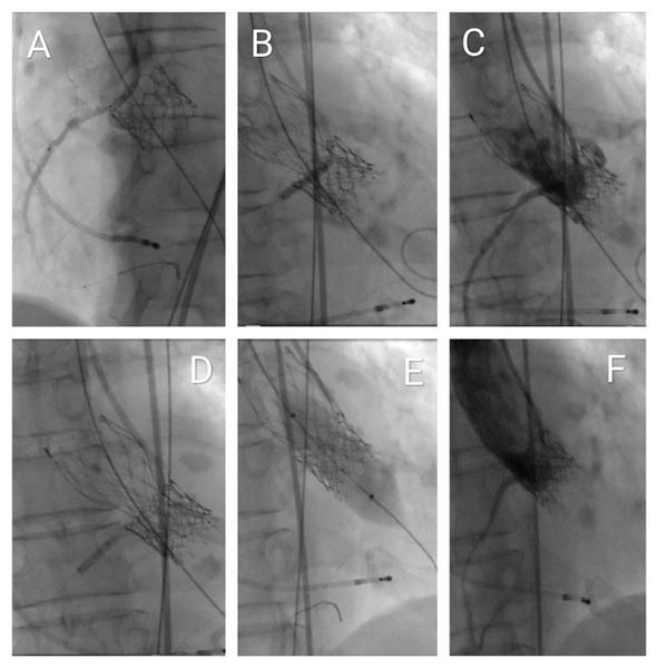 Treating severe restenosis of a 20-mm balloon-expanding valve after a transapical approach with a risk of coronary obstruction - Figure 5