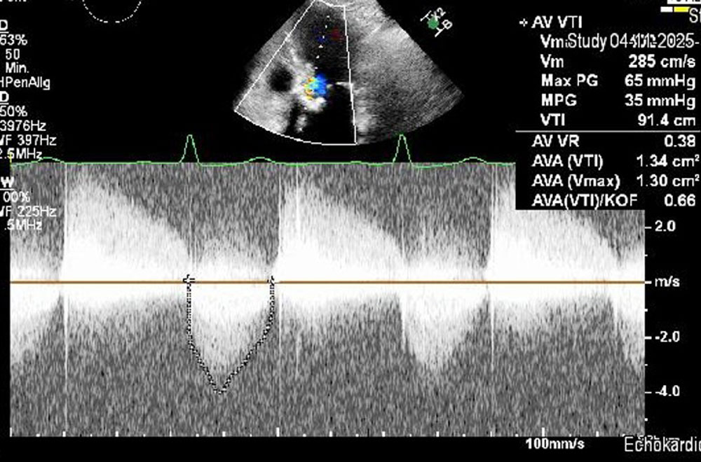 Valve-in-valve with Navitor - Figure 1