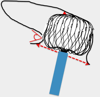 « Working » depth ≥ ostium: Technically feasible