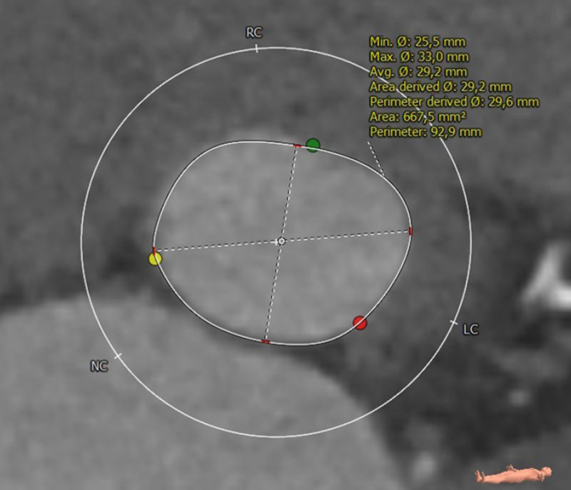 Interdisciplinary therapeutic strategy in a low-risk patient with aortic stenosis and preserved life expectancy - Figure 1